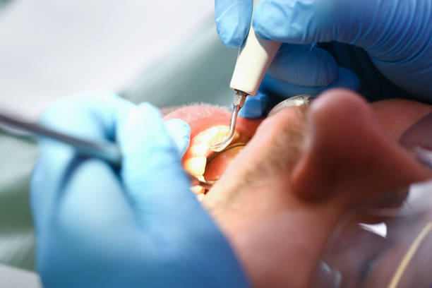 Best Emergency Dental Extractions in Lakeview, OH